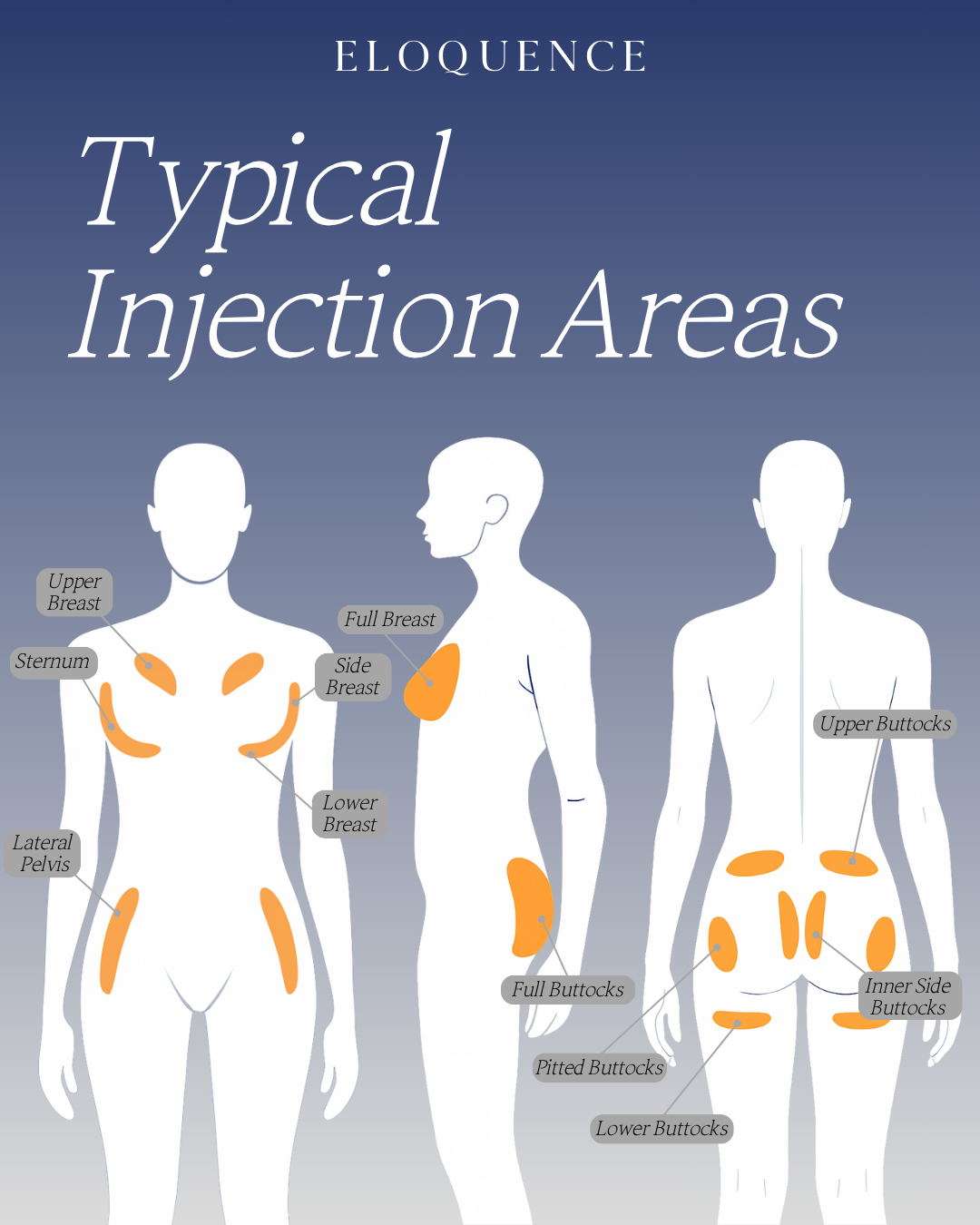 💉Eloquence Body Plus 100mL Typical Injection Areas